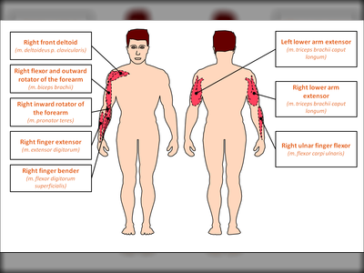 Muskeln, die beim Löschen mit Strahlrohr besonders beansprucht werden.